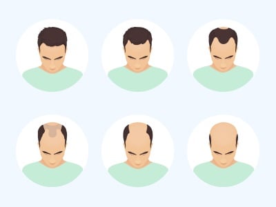Verschiedene Stadien des Haarausfalls bei Männern