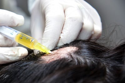 PRP-Injektion für Haare zur Behandlung von Alopezie bei einem Mann.