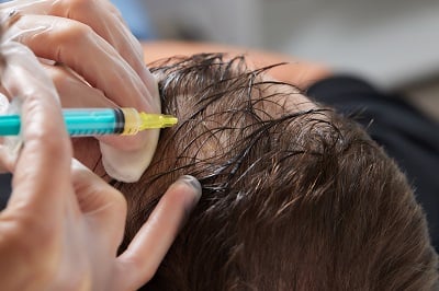 Plasmainjektion in den Kopf zur Behandlung von Haarausfall bei einem Mann.