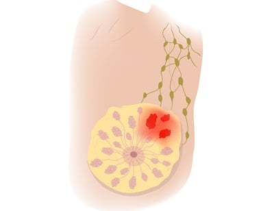 Mastitis und Entzündung der weiblichen Brust