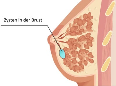 Illustration der weiblichen Brustzyste Anatomie