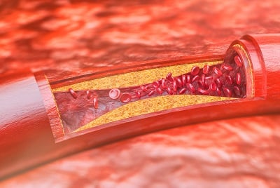 Bild der Atherosklerose, die durch Cholesterinablagerungen verursacht wird