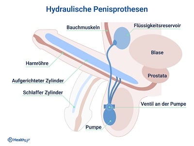 Ein Vektorbild einer Penisprothese und ihrer Struktur