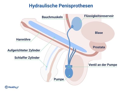  Schematische Darstellung eines Penisimplantats, das zur Behandlung der Erektionsstörungen im Alter verwendet werden kann