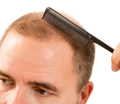 Ein Mann mit starken Geheimratsecken und Haarausfallproblemen