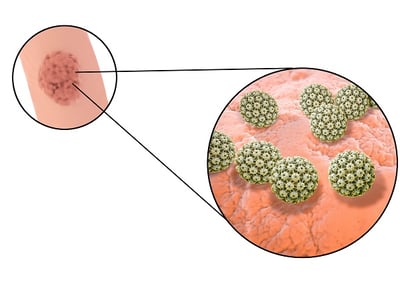Eine grafische Darstellung einer HPV-Läsion