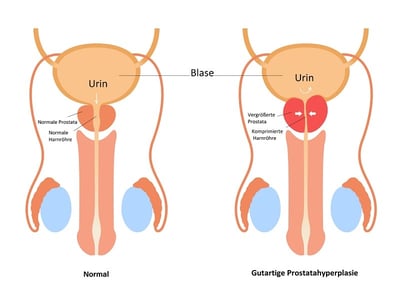 Vektorbild einer vergrößerten Prostata