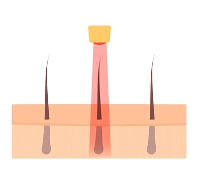 Ein Laser, der das Haarwachstum anregt