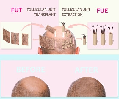 Visualisierung von 2 verschiedenen Techniken der Haartransplantation.