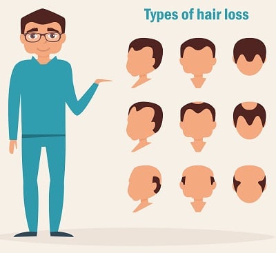 Vektorbild, das die Arten der männlichen Alopezie zeigt