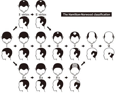Informationstabelle über die Stadien des Haarausfalls und die Arten der Kahlheit nach der Hamilton-Norwood-Skala