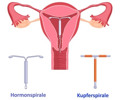 Hormonspirale und Kupferspirale