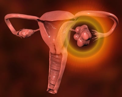 3D-Darstellung von PCOS mit gesundem Eierstock (rechts) und vergrößertem Eierstock mit Zysten (links)