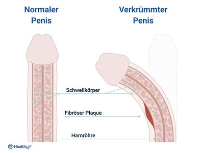 Schematische Darstellung eines normalen und eines gekrümmten Penis
