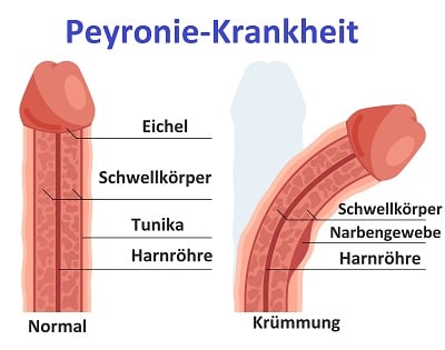 Ein Vektorbild der Peyronie-Krankheit