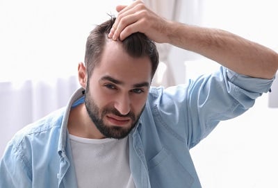 Junger Mann mit Haarausfallproblem, das Behandlung benötigt